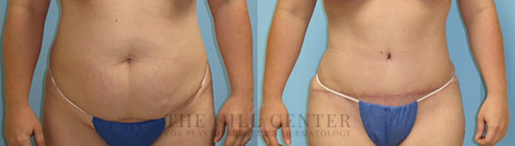 Tummy Tuck Case 231 Before & After Front | The Woodlands, TX | The Gill Center for Plastic Surgery and Dermatology