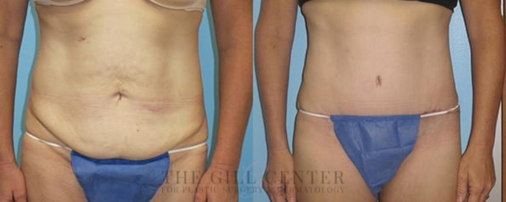 Tummy Tuck Case 232 Before & After Front | The Woodlands, TX | The Gill Center for Plastic Surgery and Dermatology