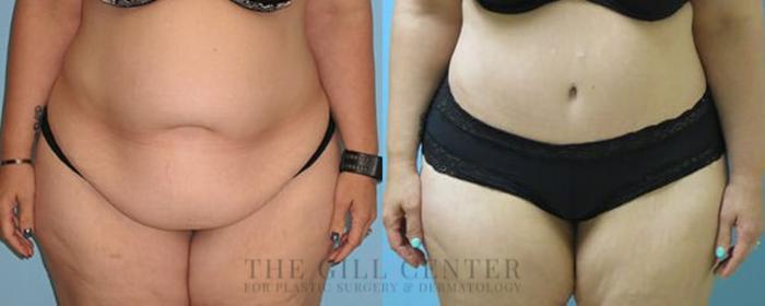 Tummy Tuck Case 233 Before & After Front | The Woodlands, TX | The Gill Center for Plastic Surgery and Dermatology