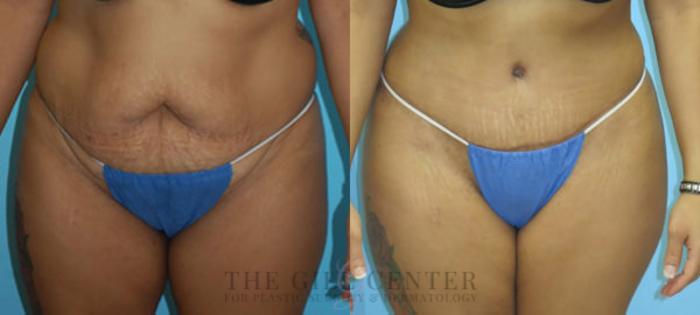 Tummy Tuck Case 234 Before & After Front | The Woodlands, TX | The Gill Center for Plastic Surgery and Dermatology