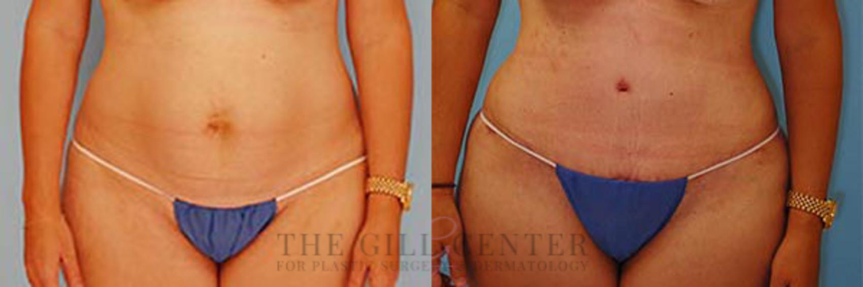 Tummy Tuck Case 235 Before & After Front | The Woodlands, TX | The Gill Center for Plastic Surgery and Dermatology