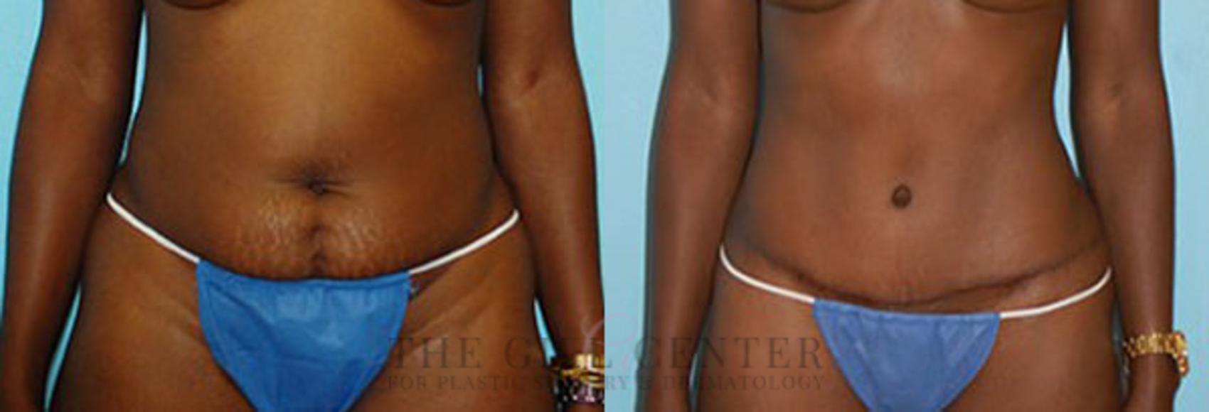 Tummy Tuck Case 236 Before & After Front | The Woodlands, TX | The Gill Center for Plastic Surgery and Dermatology