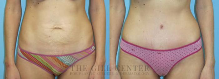 Tummy Tuck Case 238 Before & After Front | The Woodlands, TX | The Gill Center for Plastic Surgery and Dermatology