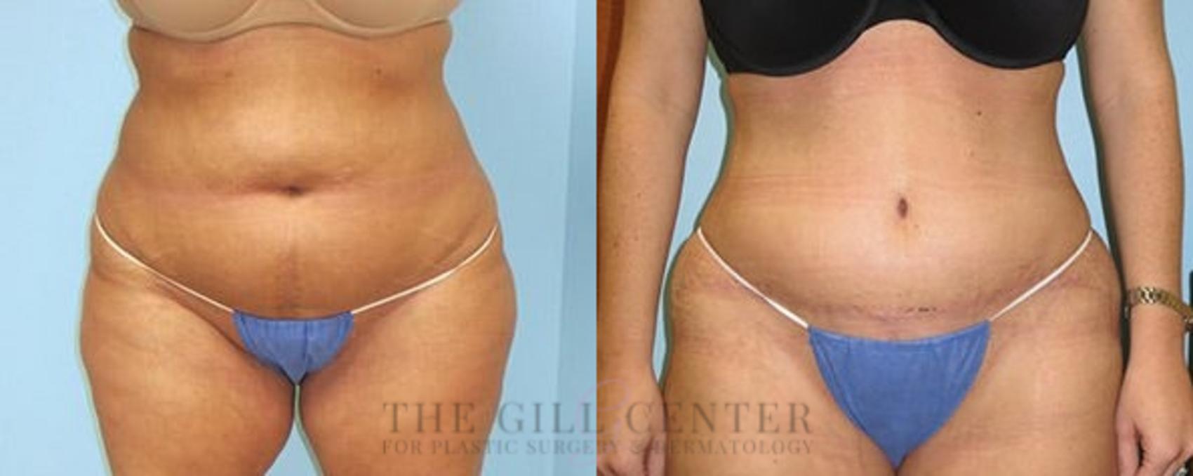 Tummy Tuck Case 243 Before & After Front | The Woodlands, TX | The Gill Center for Plastic Surgery and Dermatology