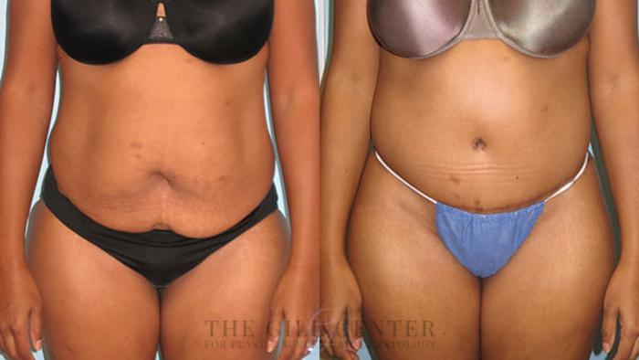 Tummy Tuck Case 247 Before & After Front | The Woodlands, TX | The Gill Center for Plastic Surgery and Dermatology