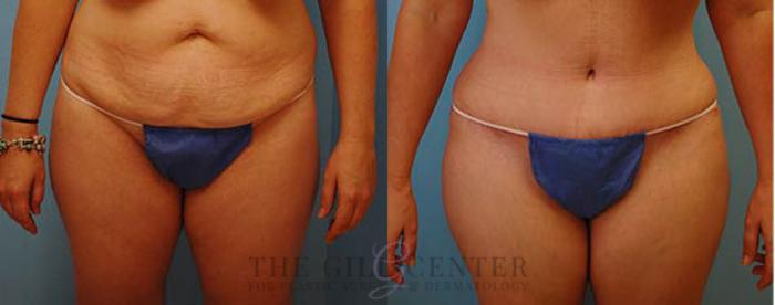 Tummy Tuck Case 248 Before & After Front | The Woodlands, TX | The Gill Center for Plastic Surgery and Dermatology