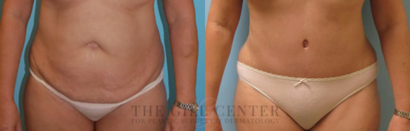 Tummy Tuck Case 250 Before & After Front | The Woodlands, TX | The Gill Center for Plastic Surgery and Dermatology