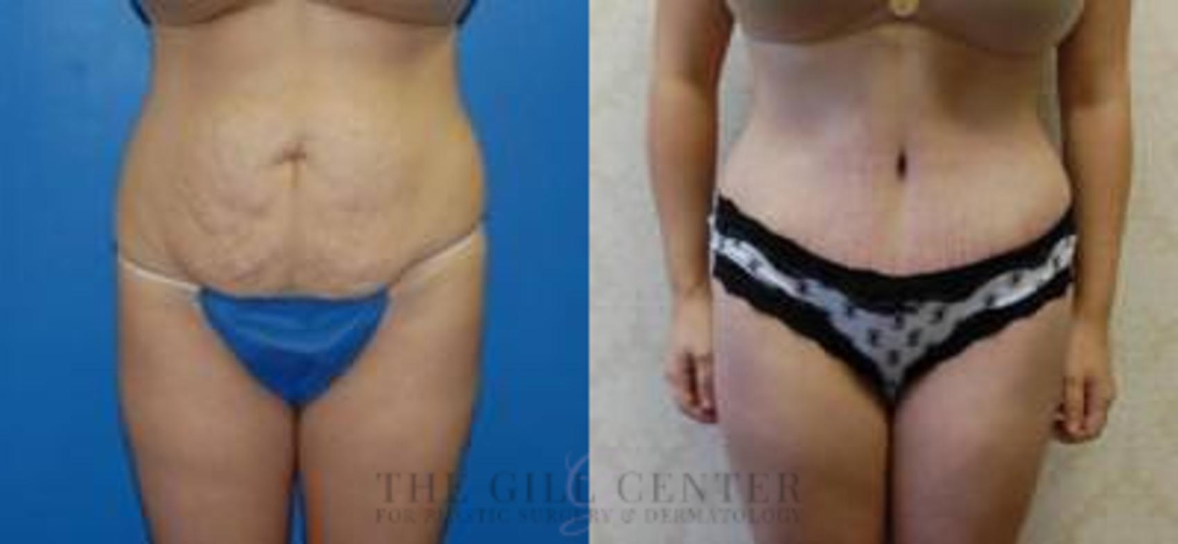 Tummy Tuck Case 251 Before & After Front | The Woodlands, TX | The Gill Center for Plastic Surgery and Dermatology