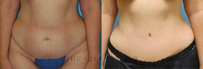 Tummy Tuck Case 254 Before & After Front | The Woodlands, TX | The Gill Center for Plastic Surgery and Dermatology