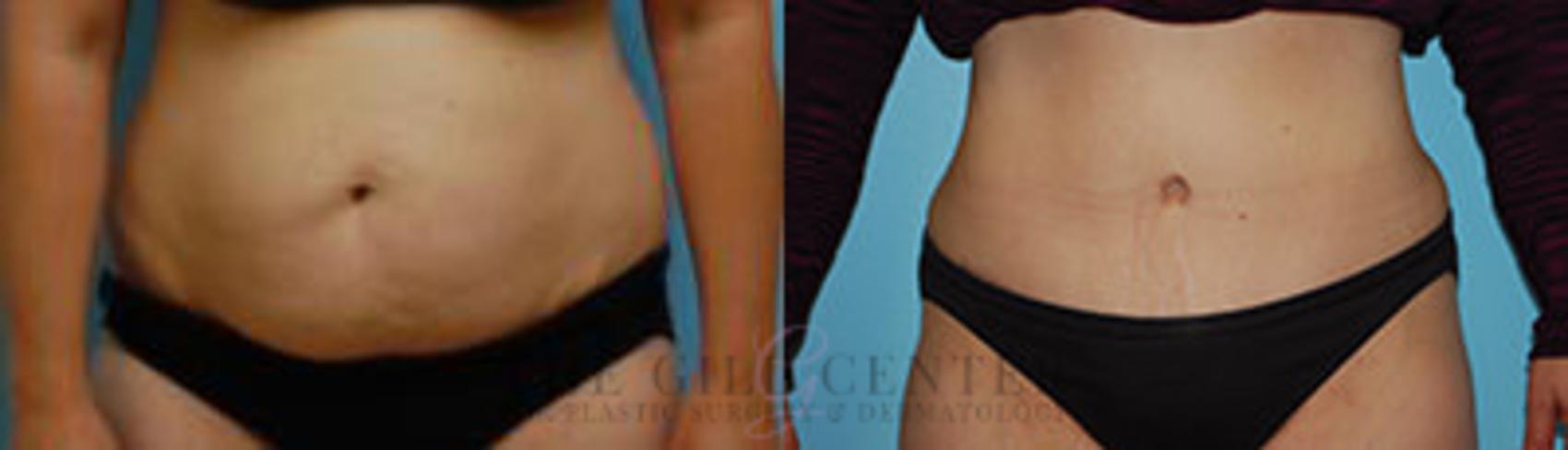 Tummy Tuck Case 259 Before & After Front | The Woodlands, TX | The Gill Center for Plastic Surgery and Dermatology
