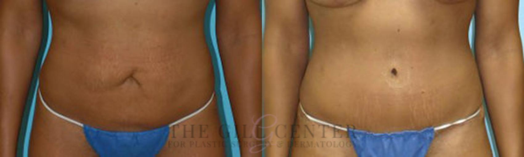 Tummy Tuck Case 271 Before & After Front | The Woodlands, TX | The Gill Center for Plastic Surgery and Dermatology