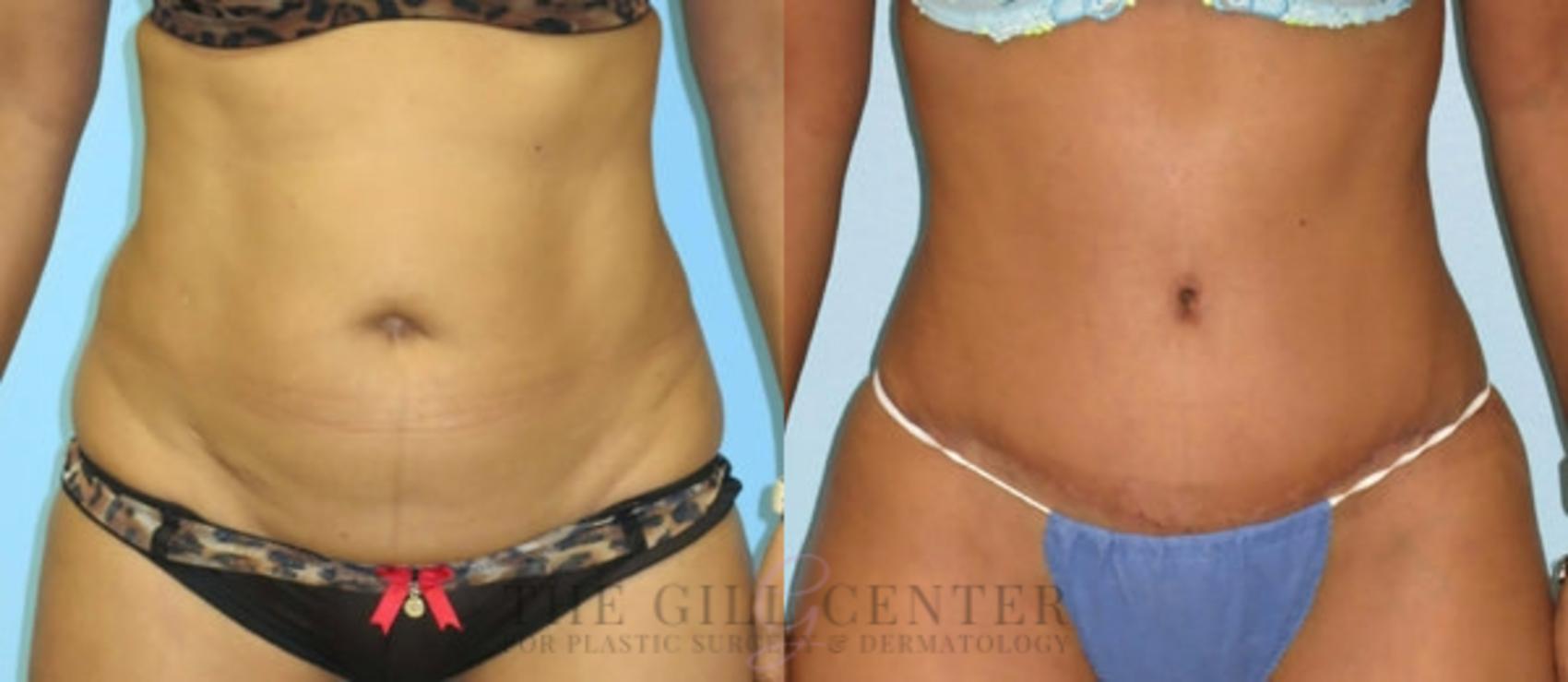 Tummy Tuck Case 272 Before & After Front | The Woodlands, TX | The Gill Center for Plastic Surgery and Dermatology