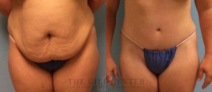 Tummy Tuck Case 274 Before & After Front | The Woodlands, TX | The Gill Center for Plastic Surgery and Dermatology