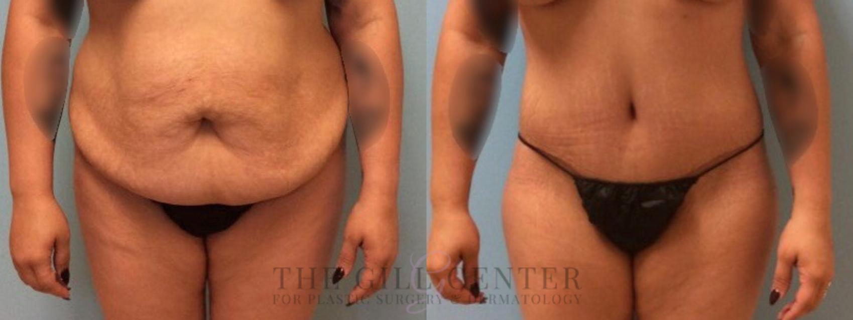 Tummy Tuck Case 275 Before & After Front | The Woodlands, TX | The Gill Center for Plastic Surgery and Dermatology