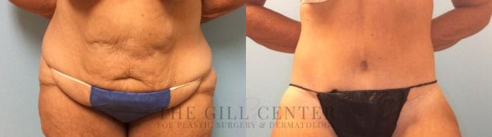 Tummy Tuck Case 276 Before & After Front | The Woodlands, TX | The Gill Center for Plastic Surgery and Dermatology