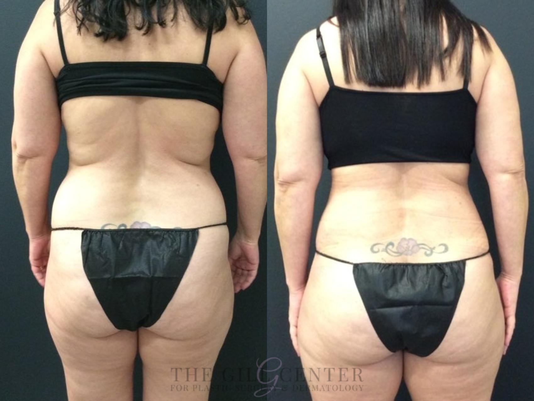 Tummy Tuck Case 424 Before & After Back | The Woodlands, TX | The Gill Center for Plastic Surgery and Dermatology