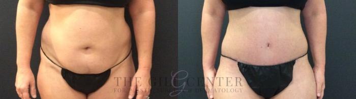 Tummy Tuck Case 424 Before & After Front | The Woodlands, TX | The Gill Center for Plastic Surgery and Dermatology