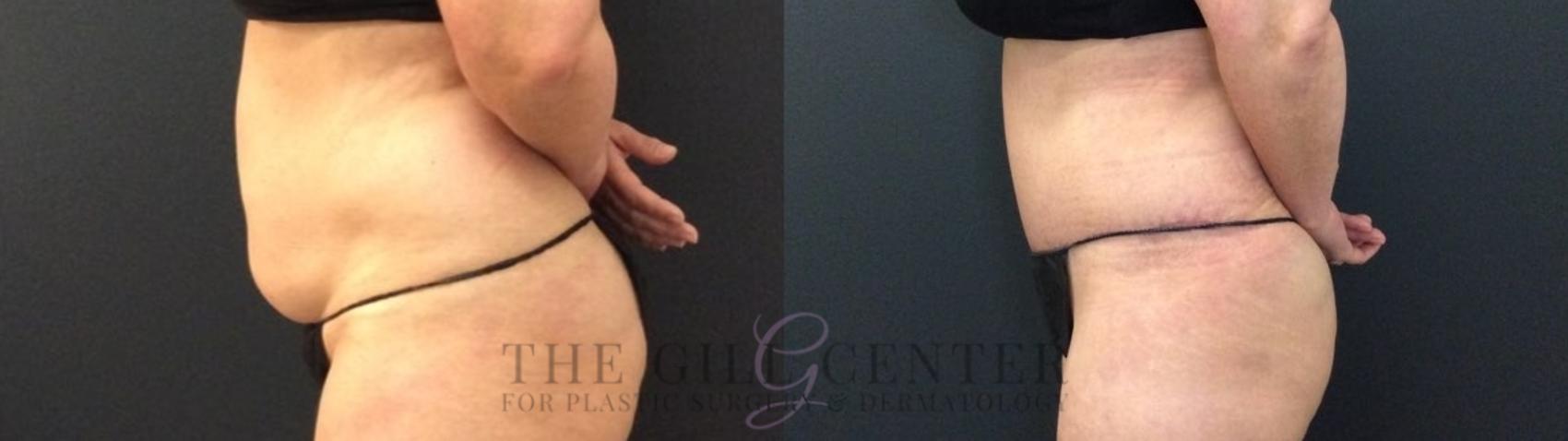 Tummy Tuck Case 424 Before & After Left Side | The Woodlands, TX | The Gill Center for Plastic Surgery and Dermatology