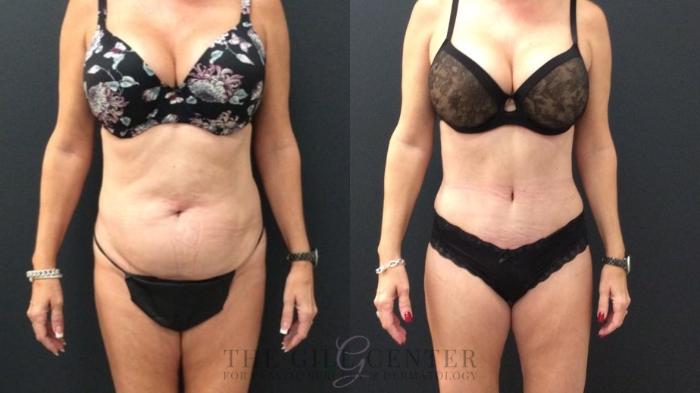 Tummy Tuck Case 436 Before & After Front | The Woodlands, TX | The Gill Center for Plastic Surgery and Dermatology
