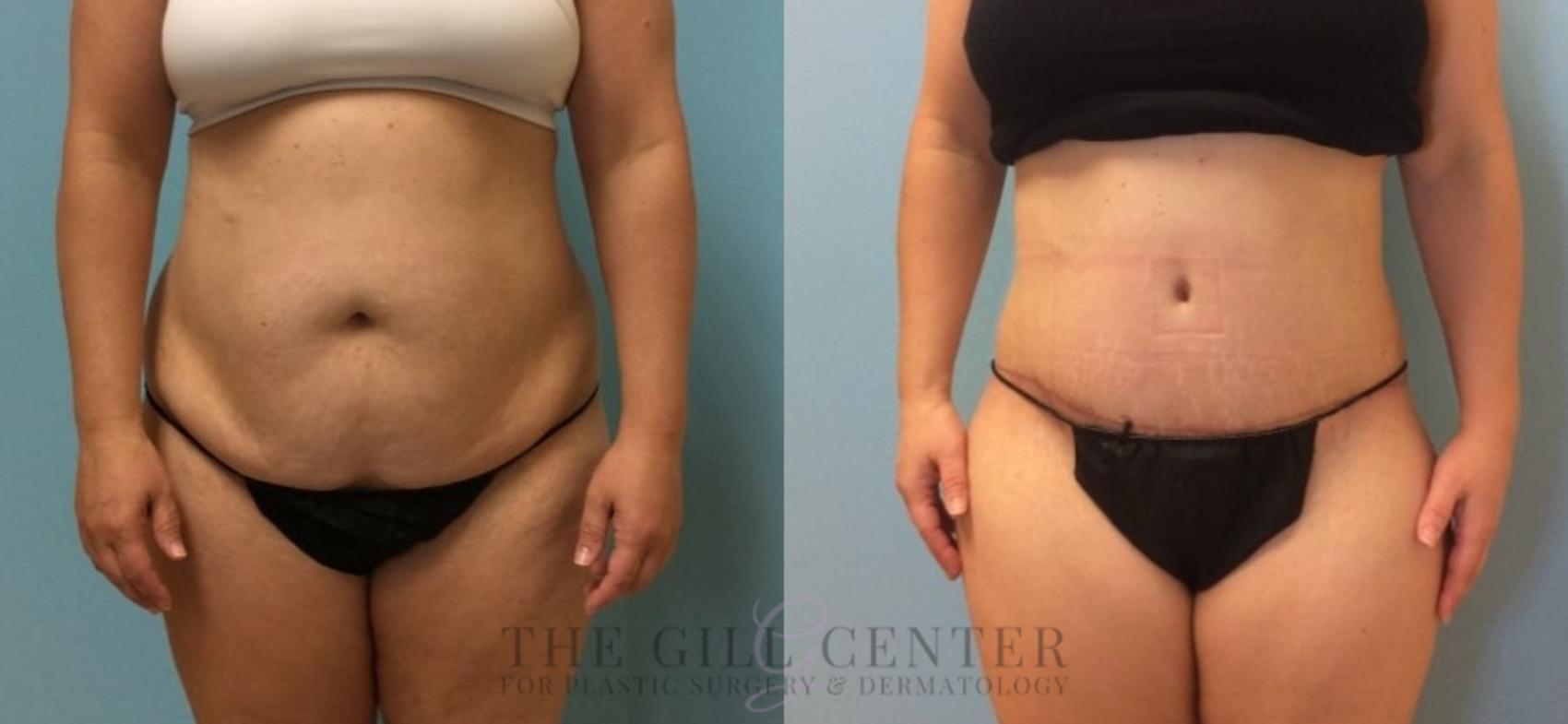 Tummy Tuck Case 442 Before & After Front | The Woodlands, TX | The Gill Center for Plastic Surgery and Dermatology