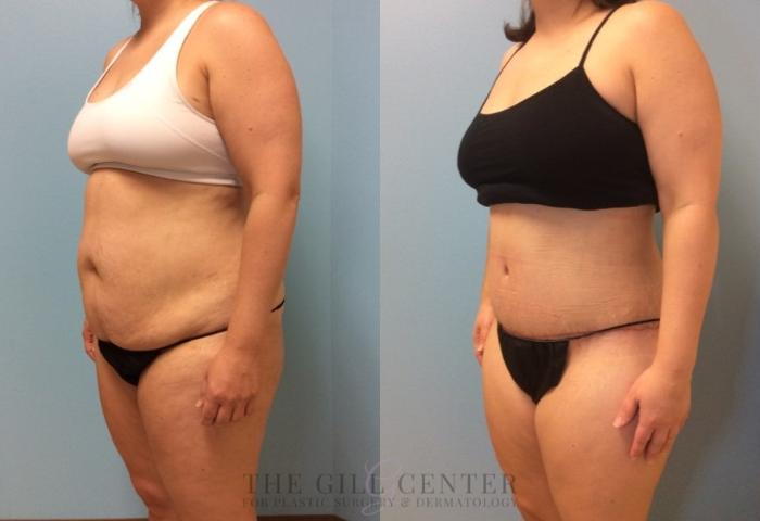 Tummy Tuck Case 442 Before & After Left Oblique | The Woodlands, TX | The Gill Center for Plastic Surgery and Dermatology