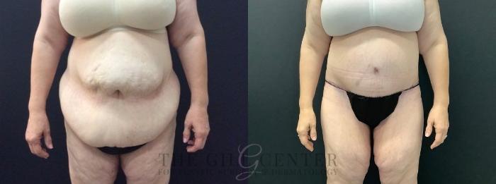 Tummy Tuck Case 450 Before & After Front | The Woodlands, TX | The Gill Center for Plastic Surgery and Dermatology