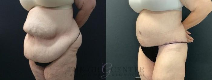 Tummy Tuck Case 450 Before & After Left Oblique | The Woodlands, TX | The Gill Center for Plastic Surgery and Dermatology