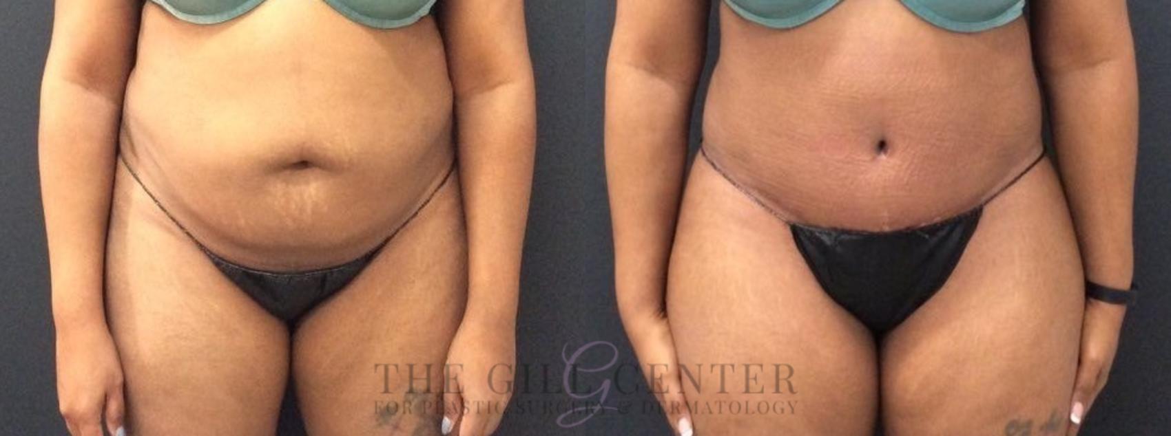 Tummy Tuck Case 454 Before & After Front | The Woodlands, TX | The Gill Center for Plastic Surgery and Dermatology