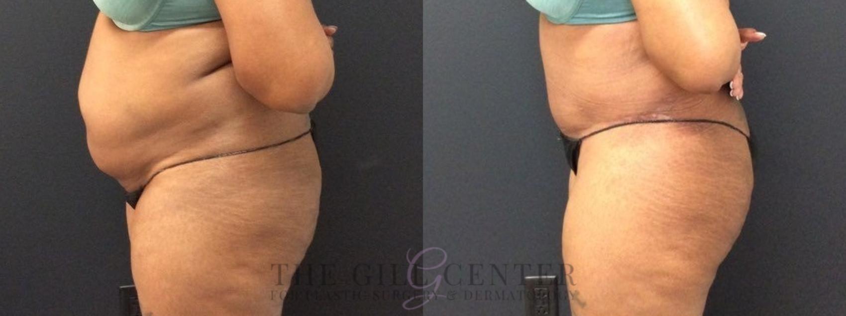 Tummy Tuck Case 454 Before & After Left Side | The Woodlands, TX | The Gill Center for Plastic Surgery and Dermatology