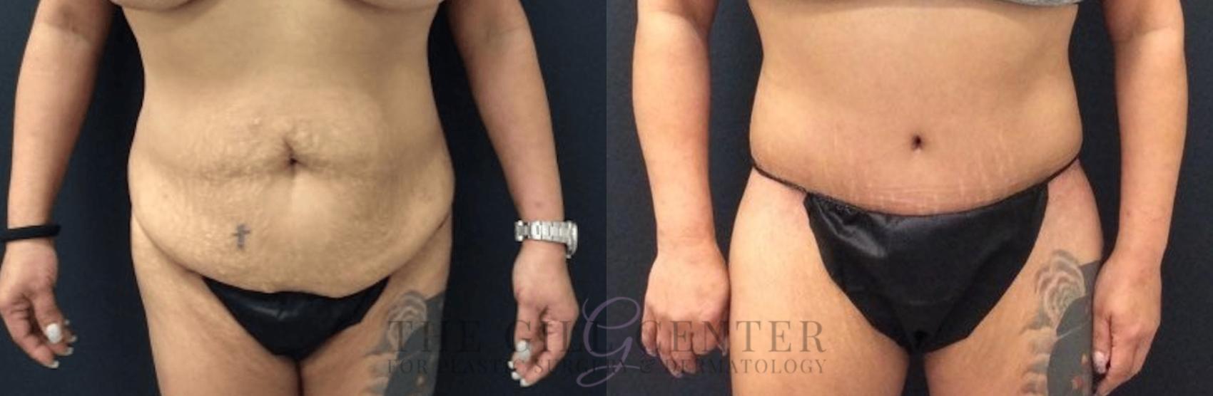 Tummy Tuck Case 455 Before & After Front | The Woodlands, TX | The Gill Center for Plastic Surgery and Dermatology