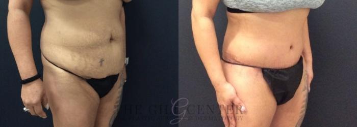Tummy Tuck Case 455 Before & After Right Oblique | The Woodlands, TX | The Gill Center for Plastic Surgery and Dermatology