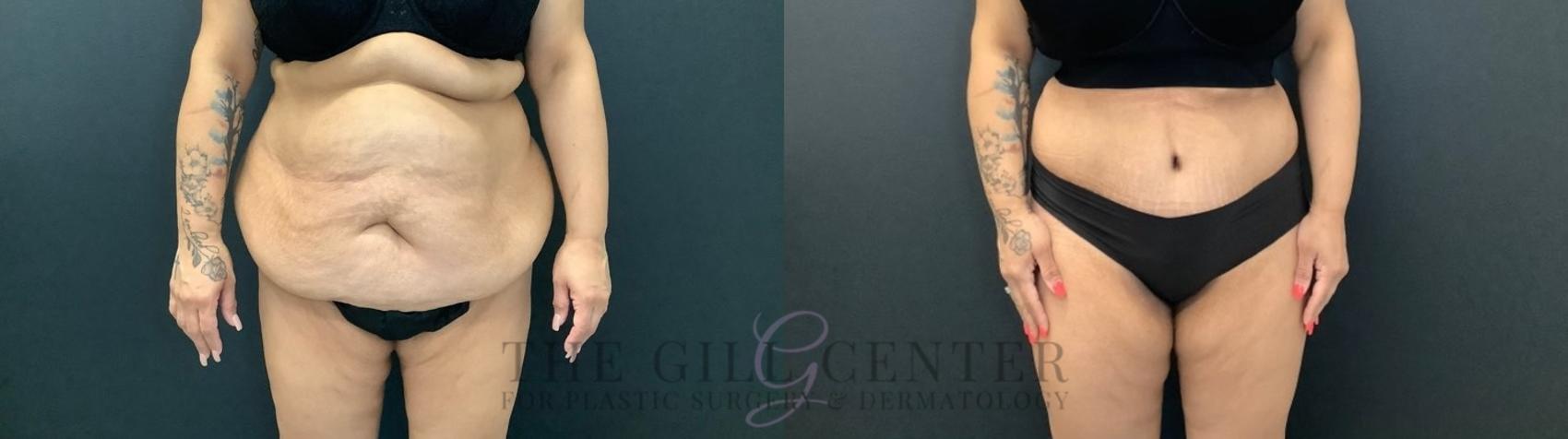 Tummy Tuck Case 458 Before & After Front | The Woodlands, TX | The Gill Center for Plastic Surgery and Dermatology