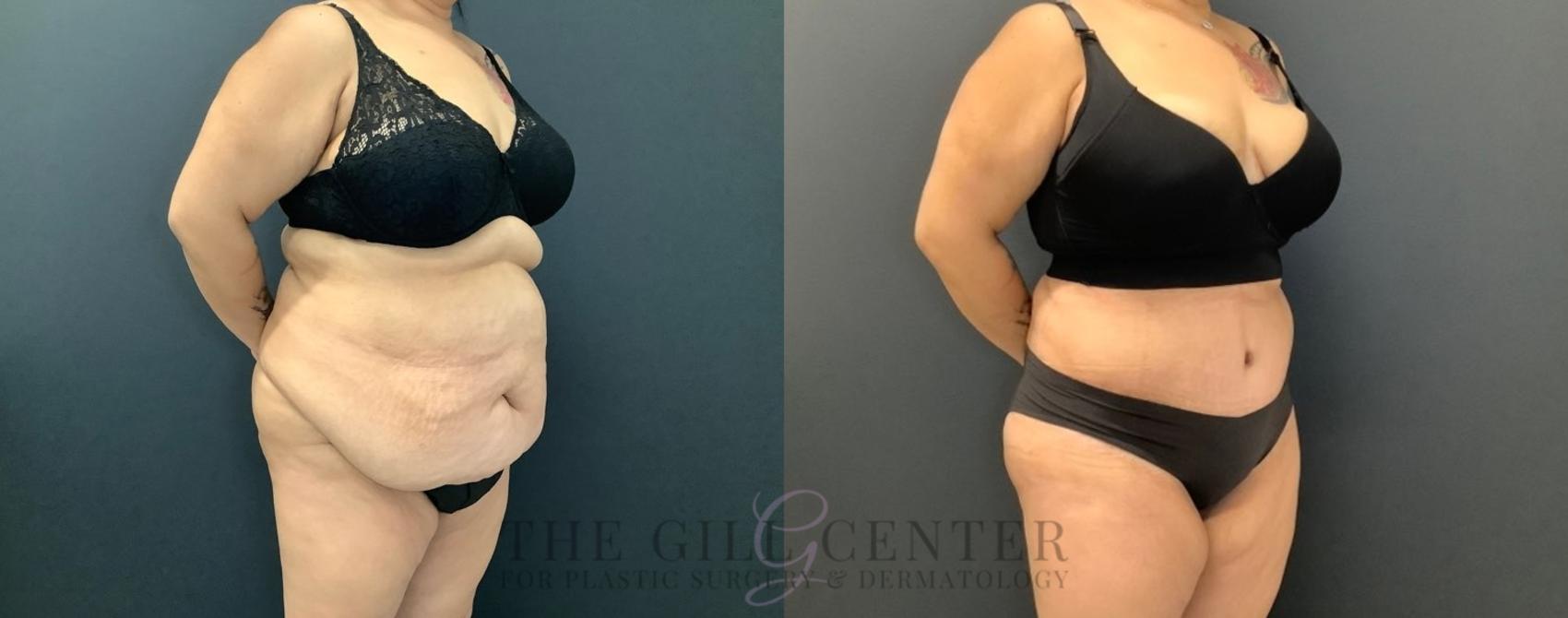 Tummy Tuck Case 458 Before & After Right Oblique | The Woodlands, TX | The Gill Center for Plastic Surgery and Dermatology