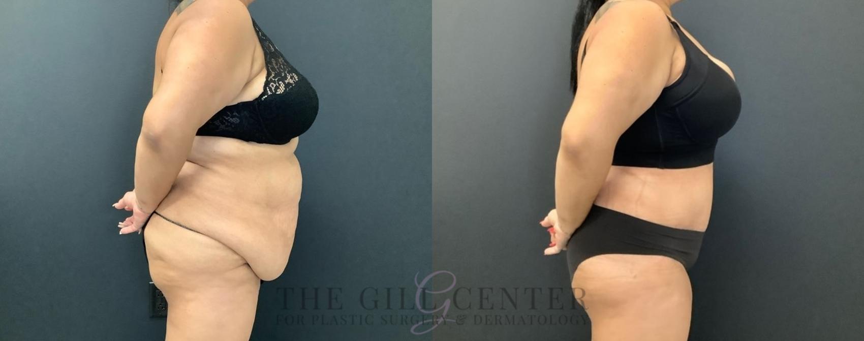Tummy Tuck Case 458 Before & After Right Side | The Woodlands, TX | The Gill Center for Plastic Surgery and Dermatology