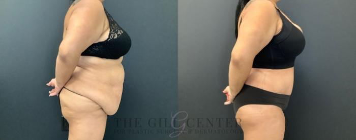 Tummy Tuck Case 458 Before & After Right Side | The Woodlands, TX | The Gill Center for Plastic Surgery and Dermatology