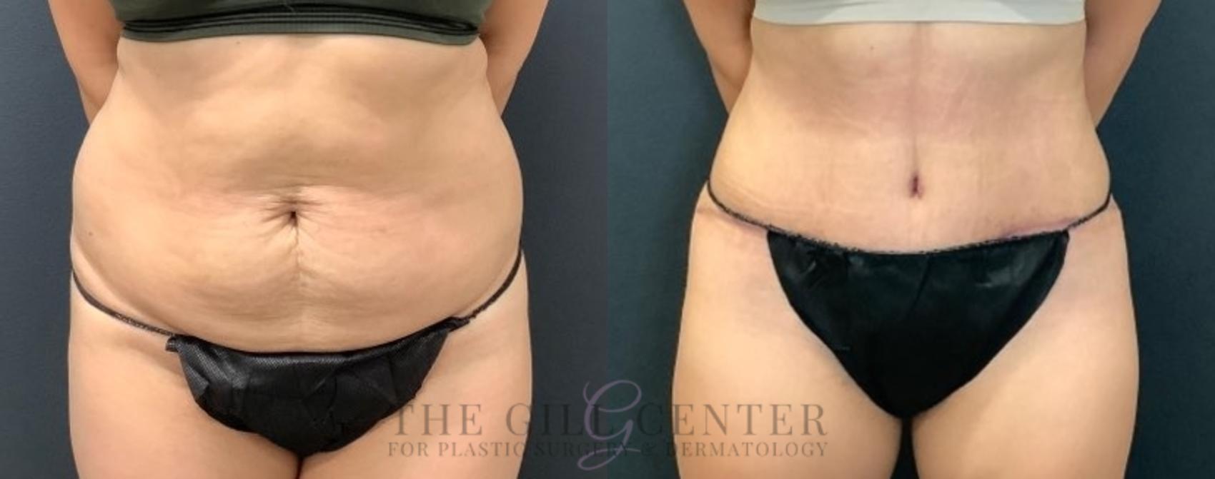 Tummy Tuck Case 459 Before & After Front | The Woodlands, TX | The Gill Center for Plastic Surgery and Dermatology
