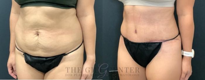 Tummy Tuck Case 459 Before & After Left Oblique | The Woodlands, TX | The Gill Center for Plastic Surgery and Dermatology
