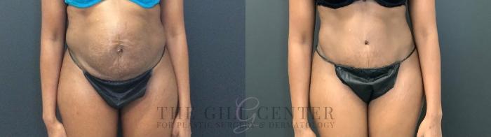 Tummy Tuck Case 466 Before & After Front | The Woodlands, TX | The Gill Center for Plastic Surgery and Dermatology