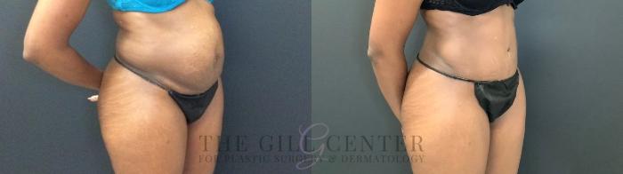 Tummy Tuck Case 466 Before & After Right Oblique | The Woodlands, TX | The Gill Center for Plastic Surgery and Dermatology