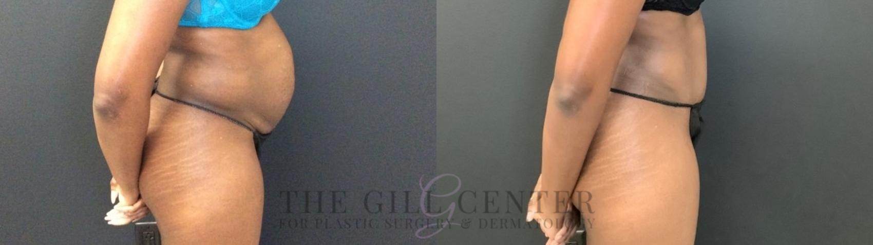 Tummy Tuck Case 466 Before & After Right Side | The Woodlands, TX | The Gill Center for Plastic Surgery and Dermatology