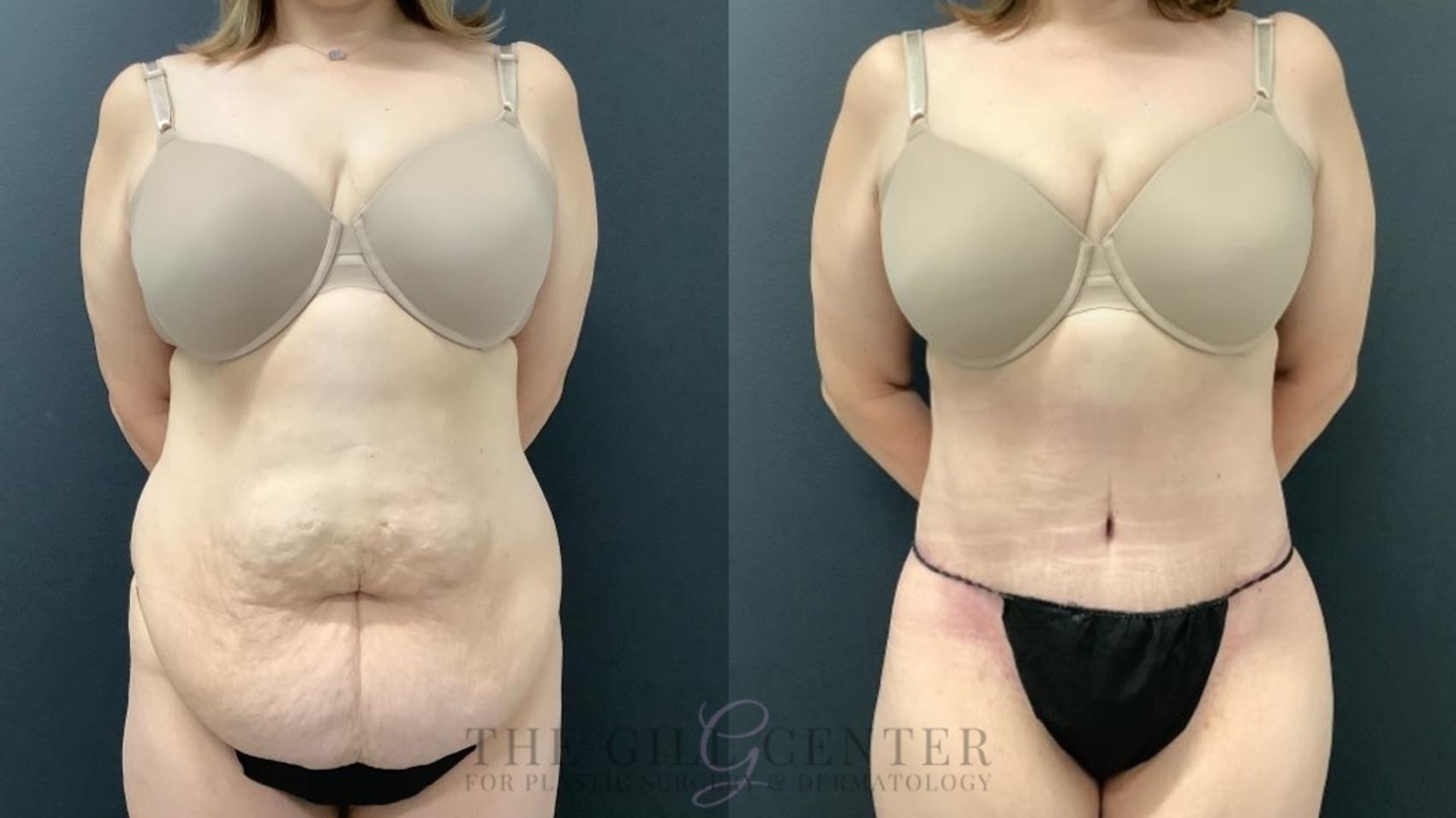 Tummy Tuck Case 467 Before & After Front | The Woodlands, TX | The Gill Center for Plastic Surgery and Dermatology