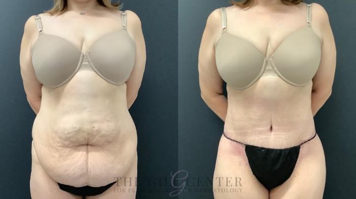 What To Expect During Recovery From Tummy Tuck Surgery – The Gill