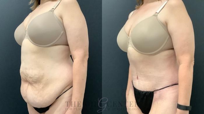 Tummy Tuck Case 467 Before & After Left Oblique | The Woodlands, TX | The Gill Center for Plastic Surgery and Dermatology