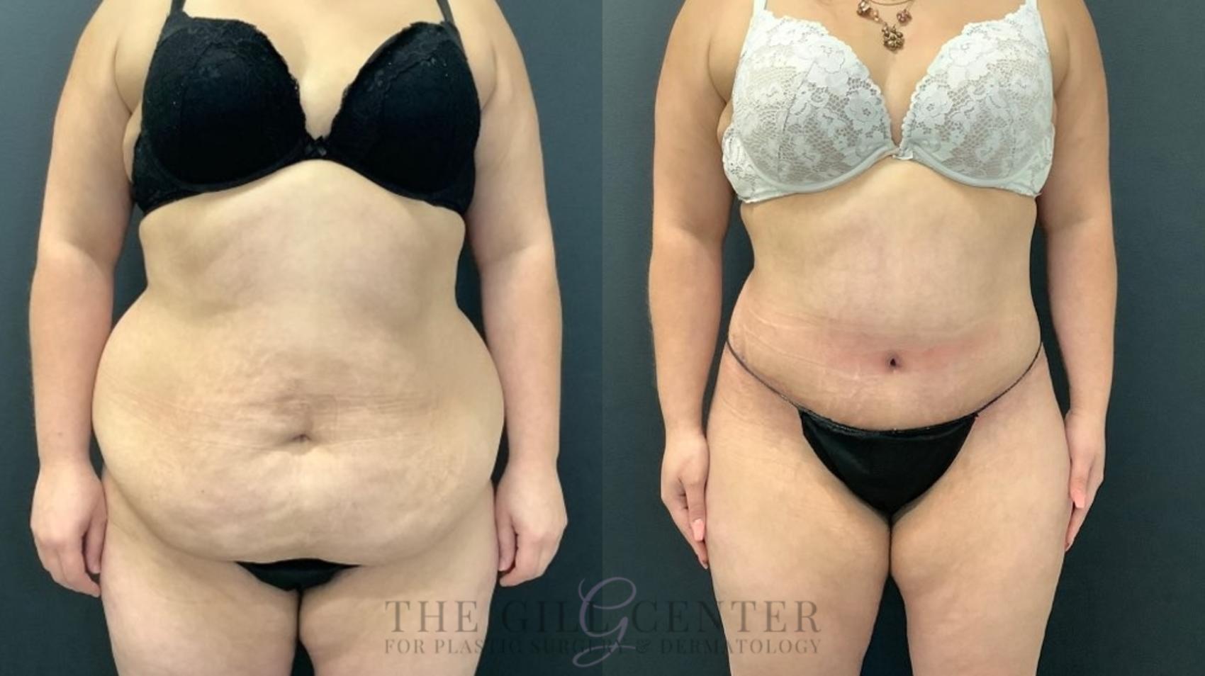 Tummy Tuck Case 468 Before & After Front | The Woodlands, TX | The Gill Center for Plastic Surgery and Dermatology