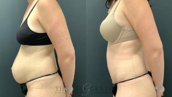 Tummy Tuck Case 469 Before & After Left Side | The Woodlands, TX | The Gill Center for Plastic Surgery and Dermatology