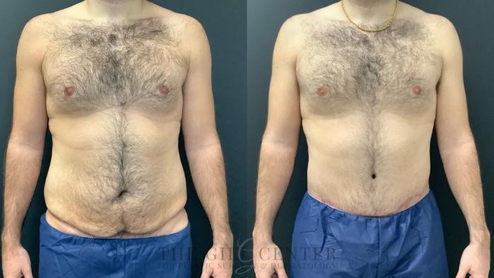 Tummy Tuck Case 476 Before & After Front | The Woodlands, TX | The Gill Center for Plastic Surgery and Dermatology
