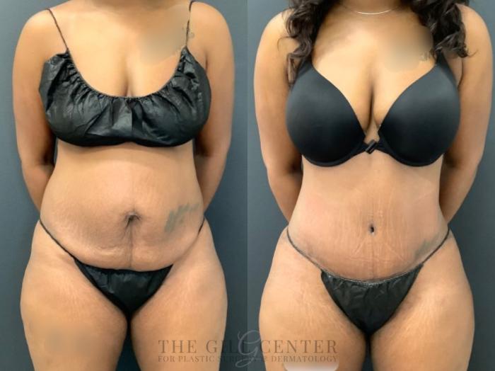 Tummy Tuck Case 488 Before & After Front | The Woodlands, TX | The Gill Center for Plastic Surgery and Dermatology