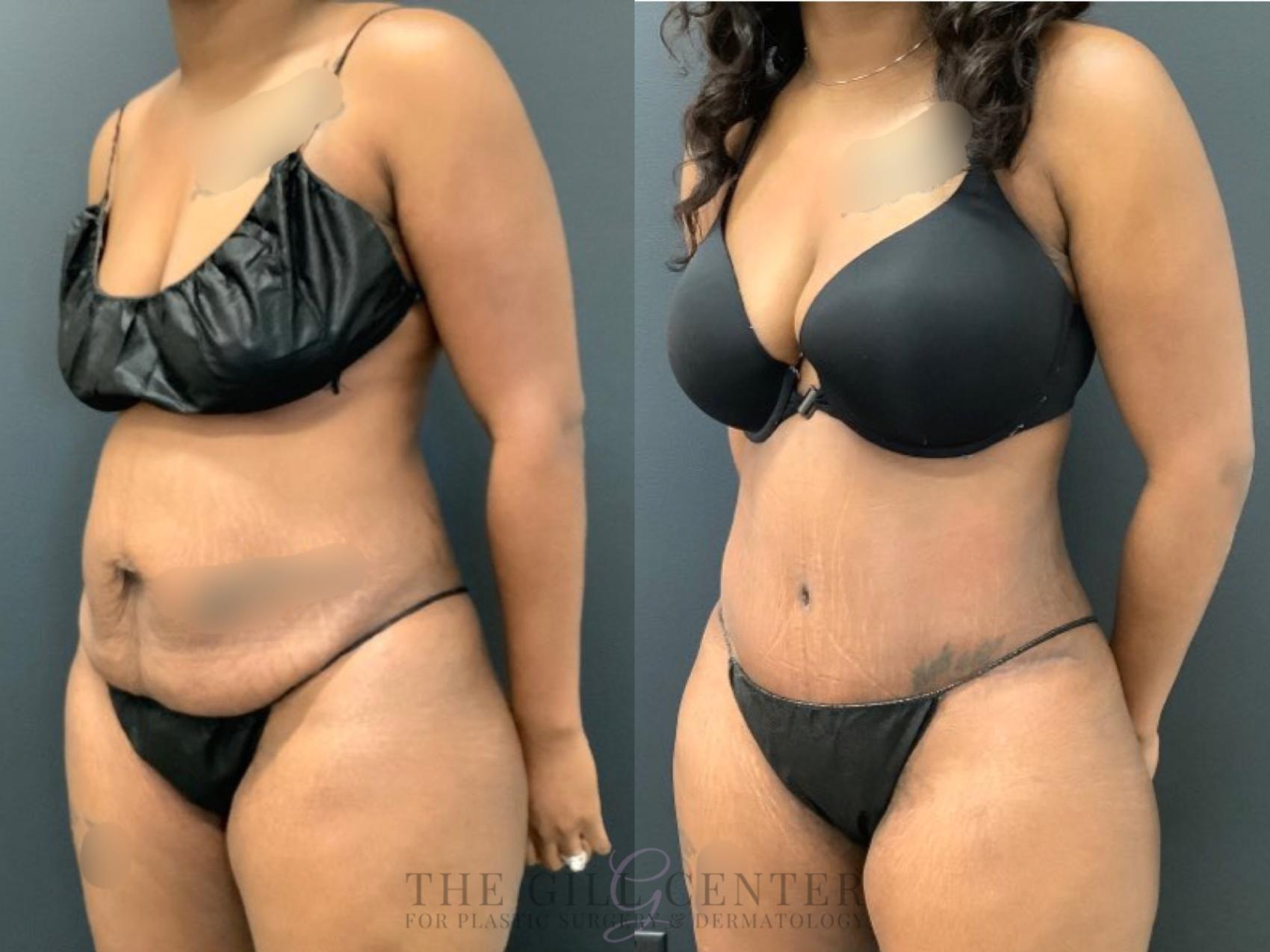 Tummy Tuck Case 488 Before & After Left Oblique | The Woodlands, TX | The Gill Center for Plastic Surgery and Dermatology
