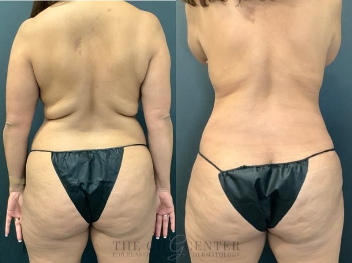 Tummy Tuck Case 492 Before & After Back | The Woodlands, TX | The Gill Center for Plastic Surgery and Dermatology