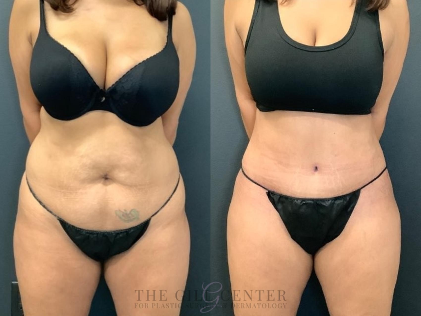 Tummy Tuck Case 492 Before & After Front | The Woodlands, TX | The Gill Center for Plastic Surgery and Dermatology